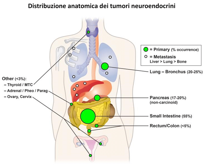 Tumore neuroendocrino : cause, sintomi e terapia