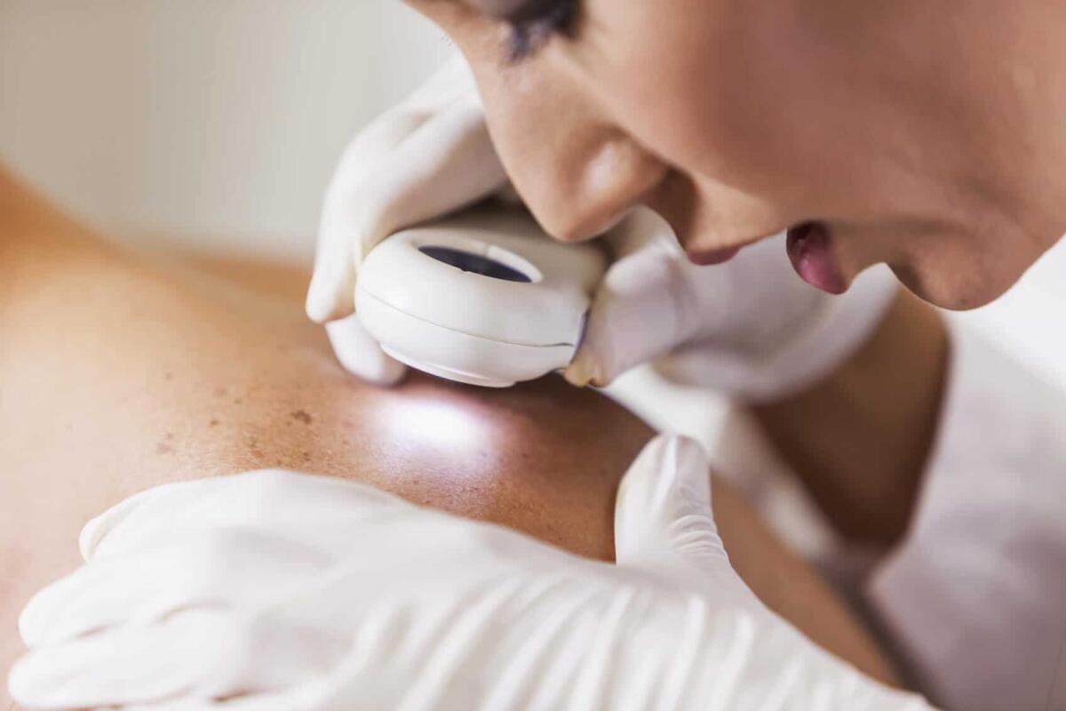 Melanoma: mappe spaziali e nuove frontiere - Credits: Dermatologa Pozzi