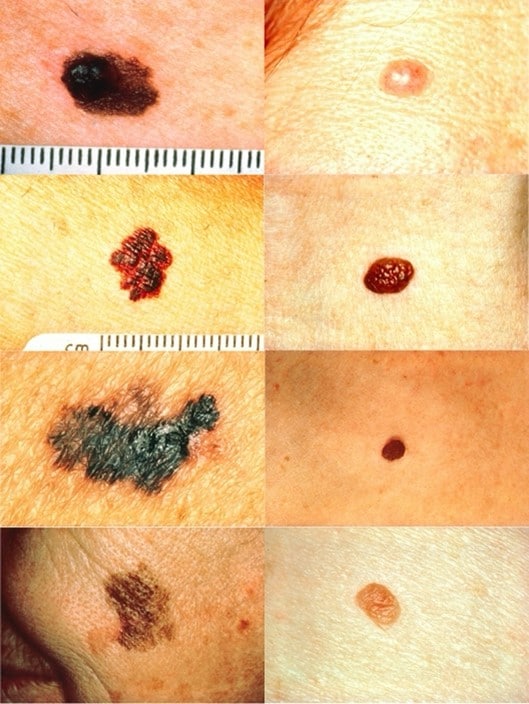 Differenza tra melanomi (a sinistra) e nei normali (a destra)  - Credits: National Cancer Institute via Skin Cancer Foundation