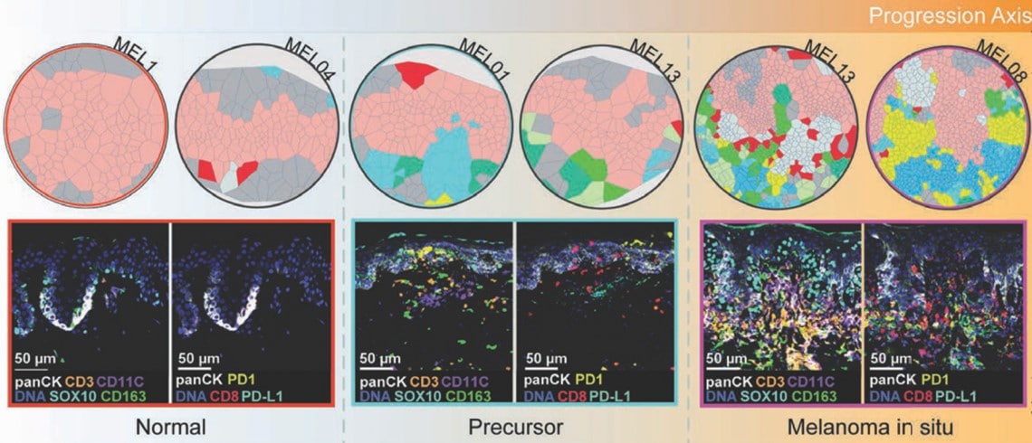 Nella prima riga, evoluzione di un neo in melanoma visto da una mappa spaziale (diagramma di Voronoi). Nella seconda, immagini prese da pazienti per ciascuna delle casistiche riportate nella riga superiore - Credits: Cancer Discovery