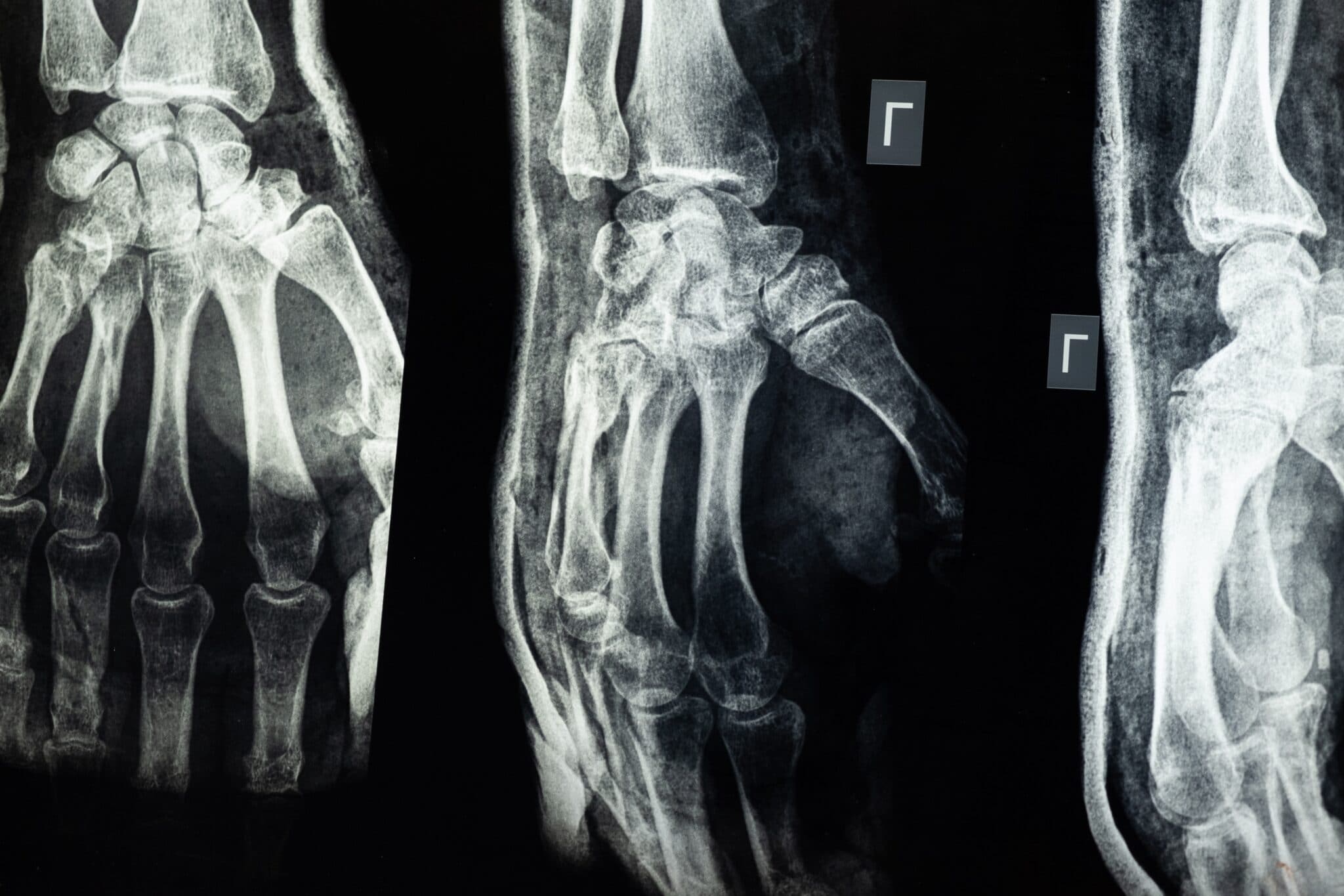 radiografia pellicola radiografica