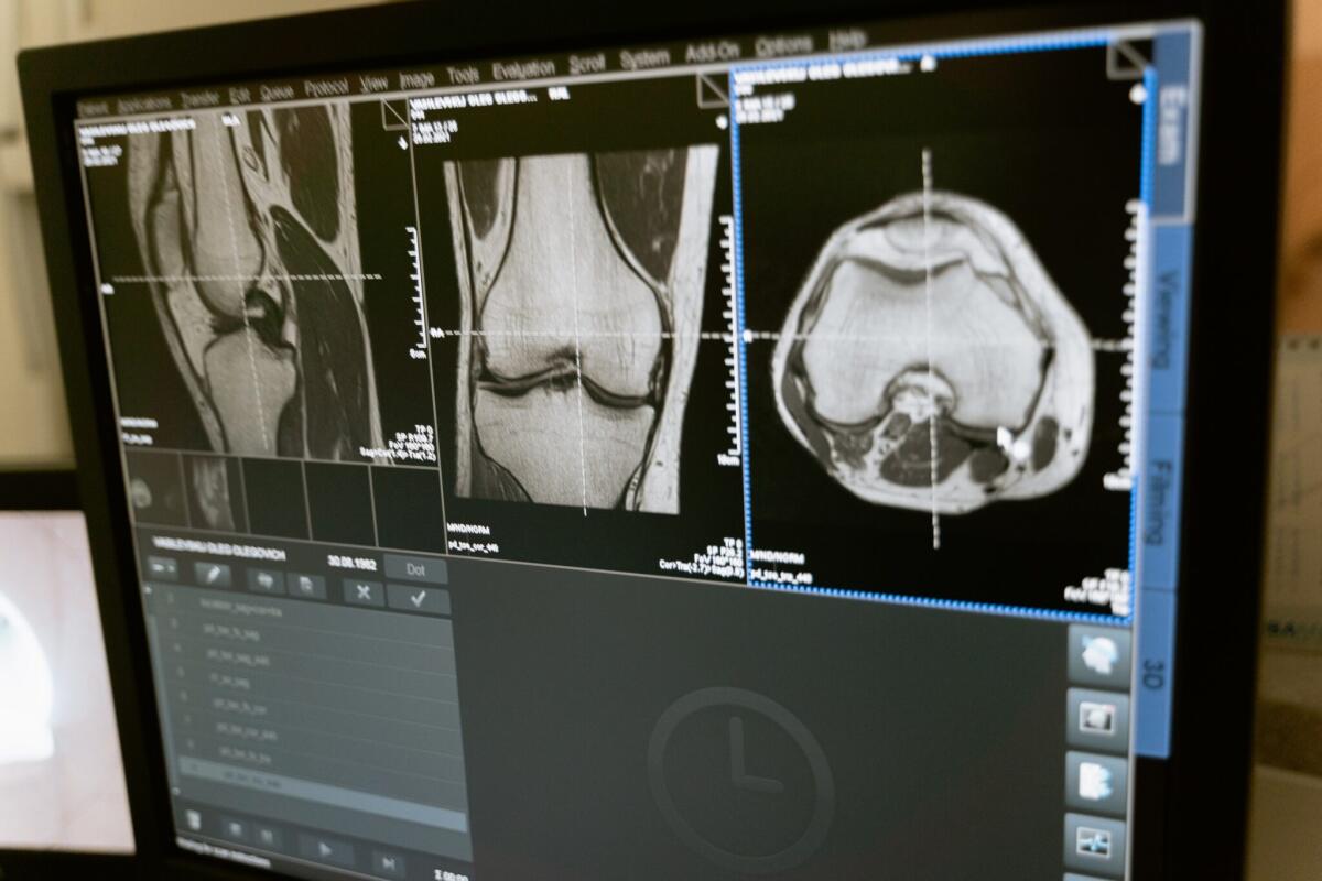 Osteoartrite: un hydrogel iniettabile potrebbe salvare le articolazioni ferite - 