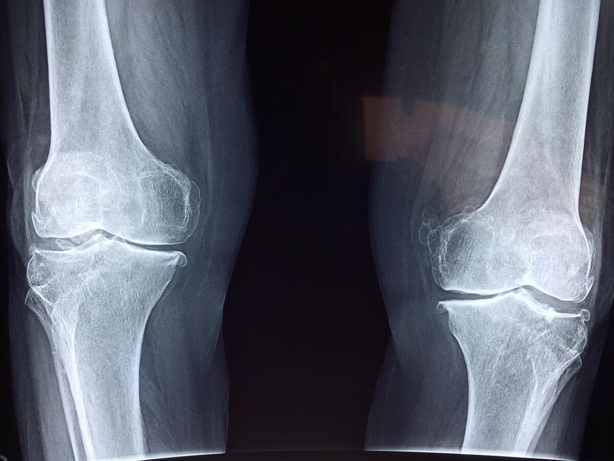 Osteoporosi: un ormone naturale potrebbe offrirne un miglior trattamento - 