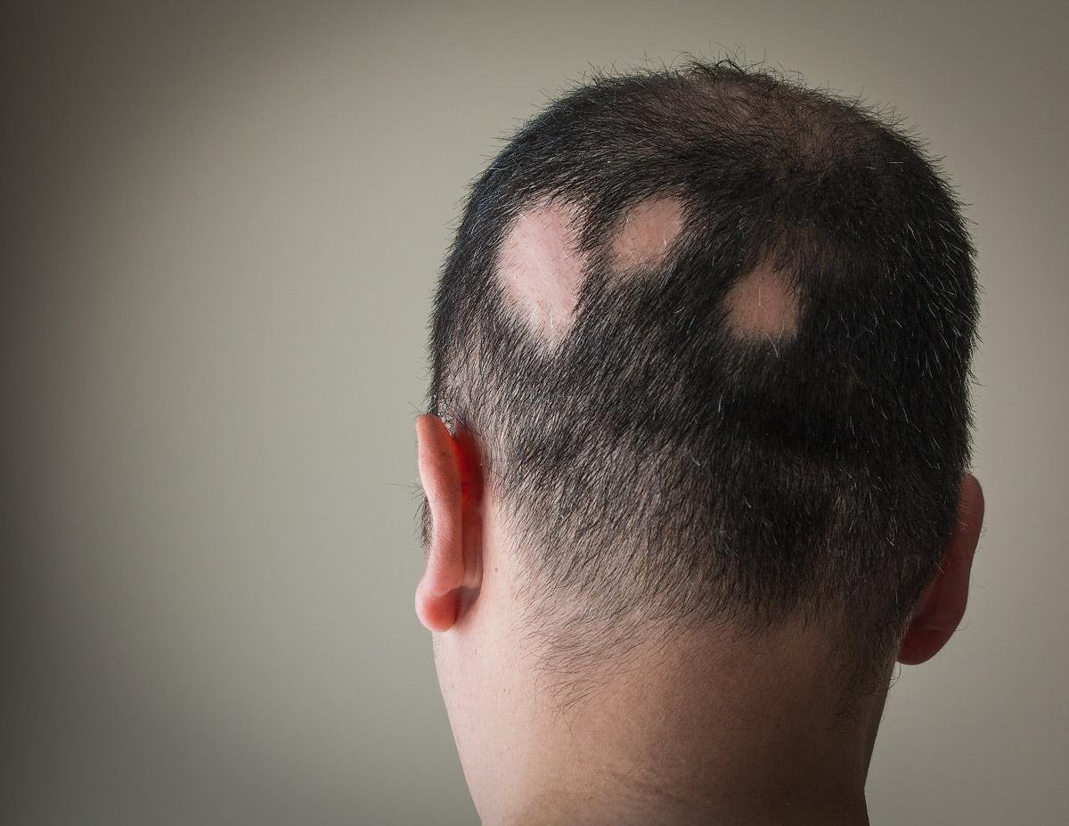 Alopecia areata: cos'è, come si manifesta e quali sono i possibili rimedi - 