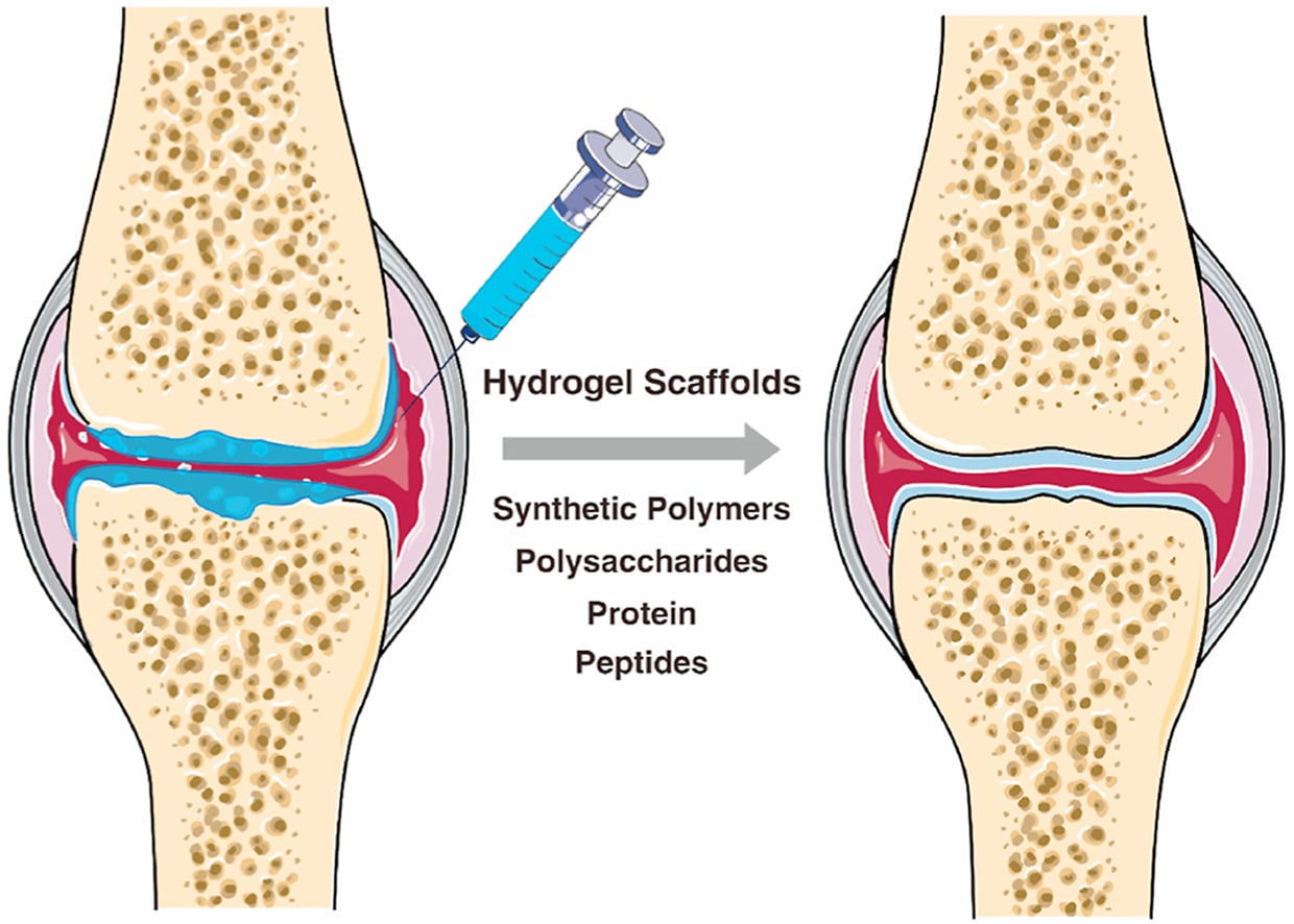 Iniezione di hydrogel - Credits: Bioactive Materials