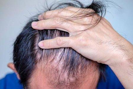 alopecia areata