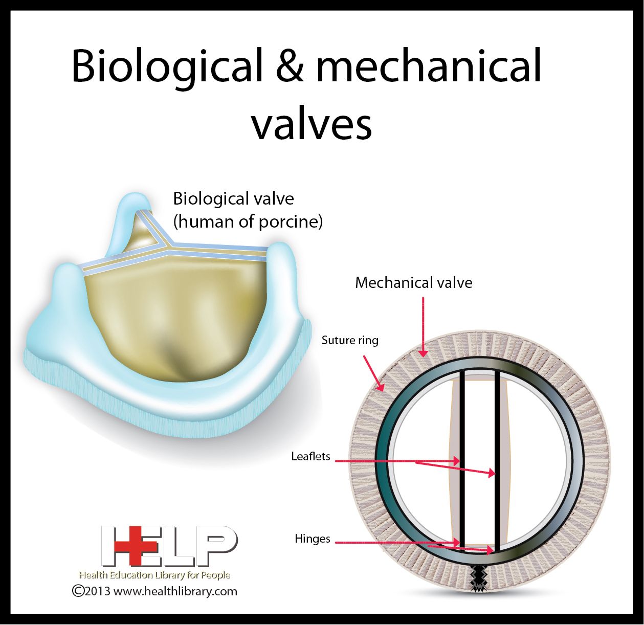 Protesi valvolare meccanica (a sx) e protesi valvolare biologica (a dx) – Credits: HELP