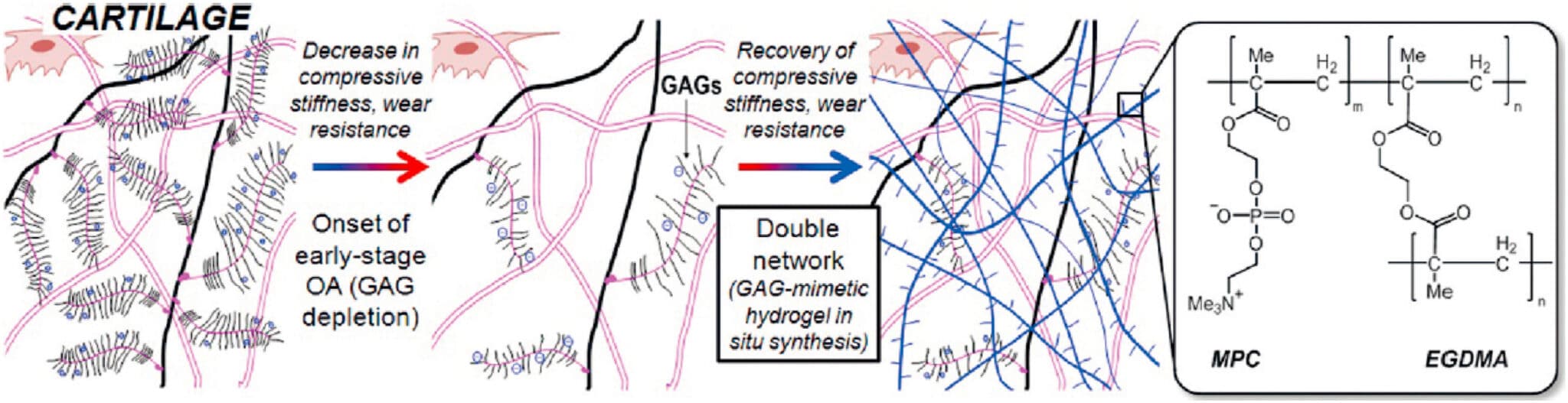 Rappresentazione schematica della cartilagine normale (a sinistra), della cartilagine osteoartritica (al centro) e della cartilagine rinforzata con hydrogel (a destra) - Credits: Bioactive Materials