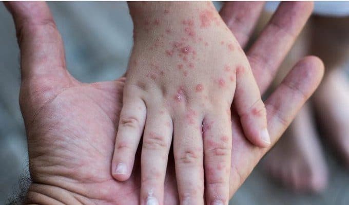 Virus del vaiolo delle scimmie: tutto quello che c'è da sapere