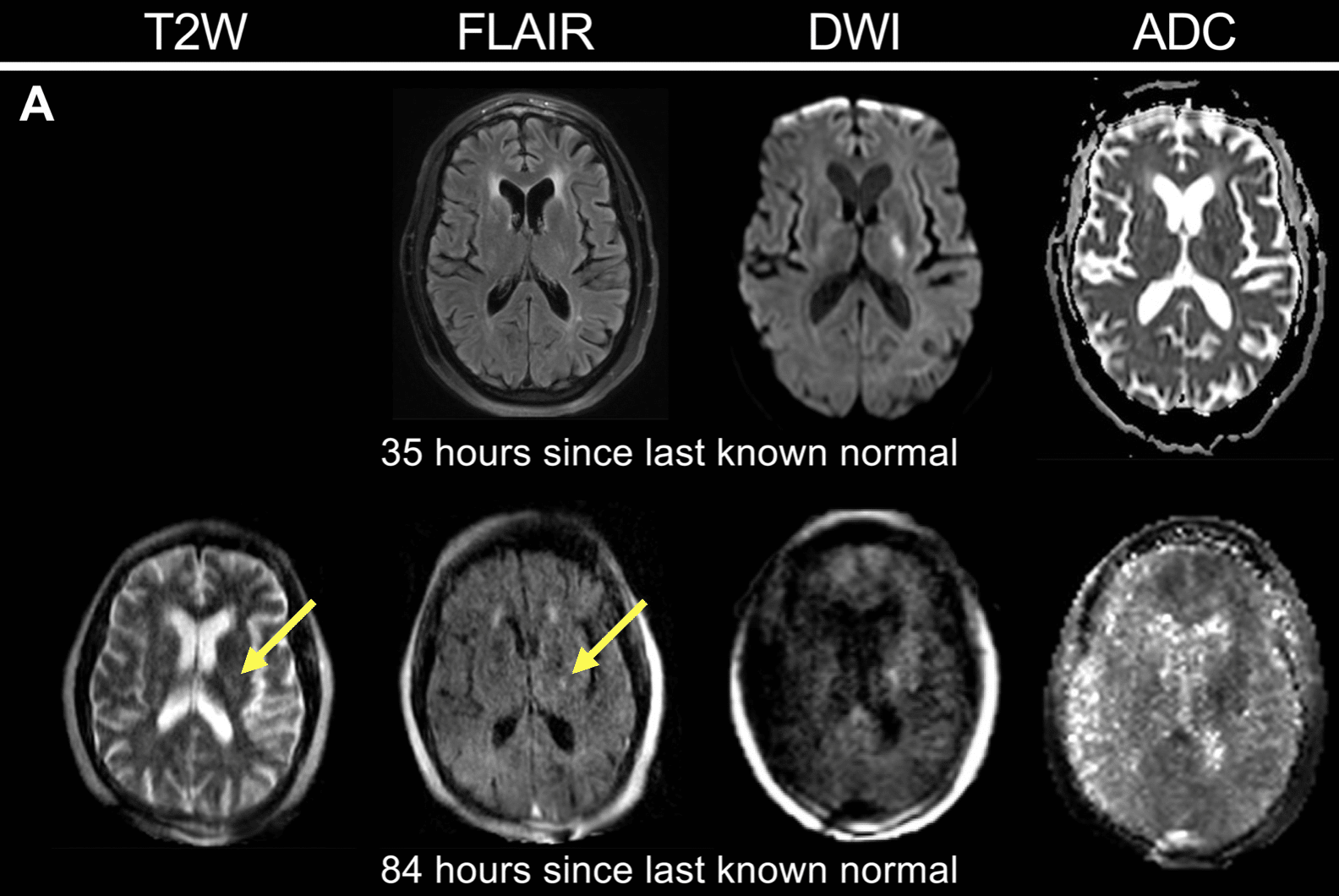 Monitoraggio dello sviluppo dell'ictus ischemico con la pMRI - Credits: Science