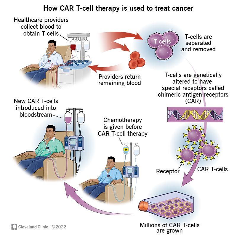 Funzionamento terapia CAR-T - Credits: Cleveland Clinic