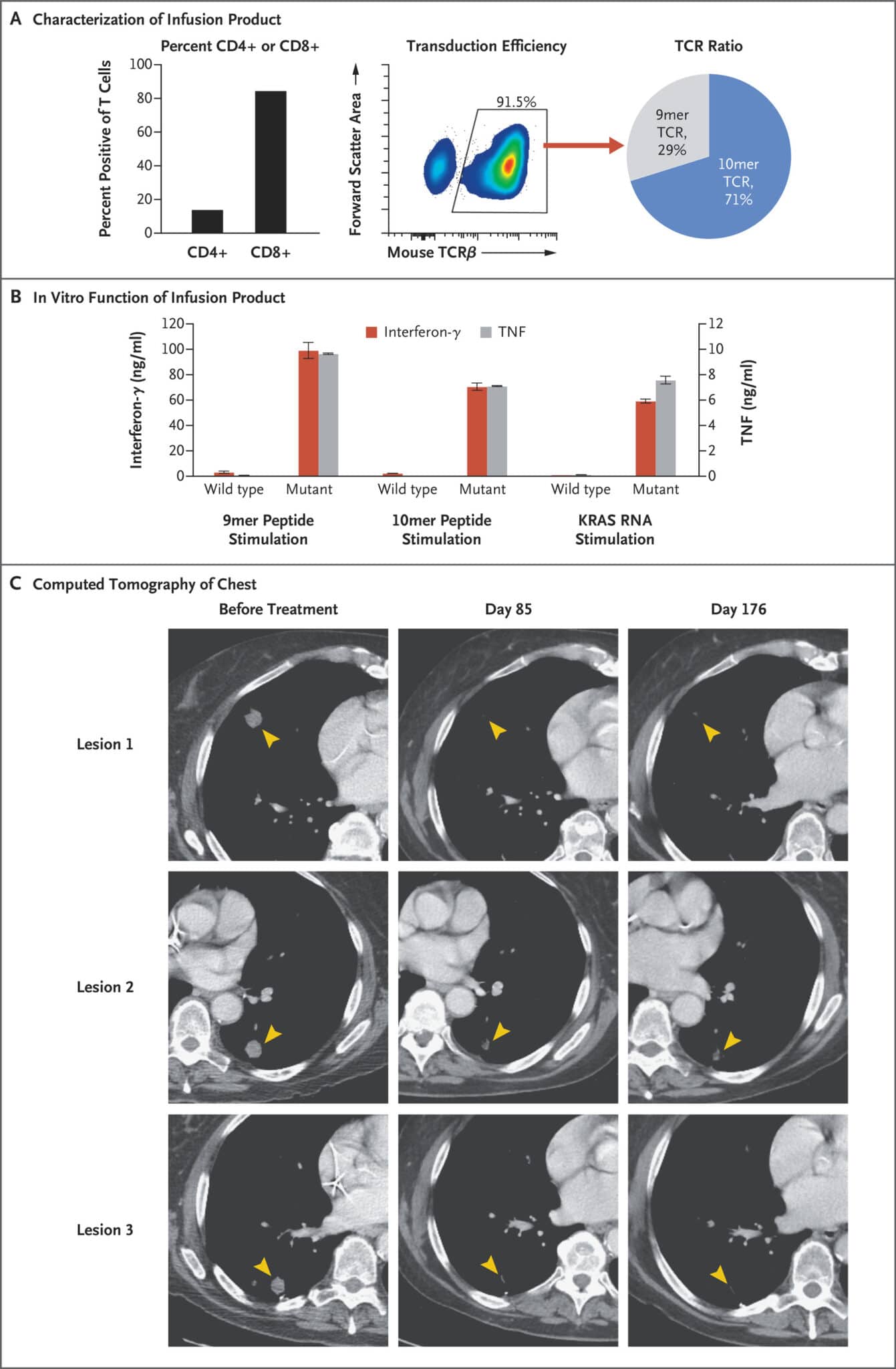 Immunoterapia adottiva con cellule T ingegnerizzate con recettore delle cellule T (TCR) mirate a KRAS G12D in un paziente con tumore pancreas - Credits: nejm.org