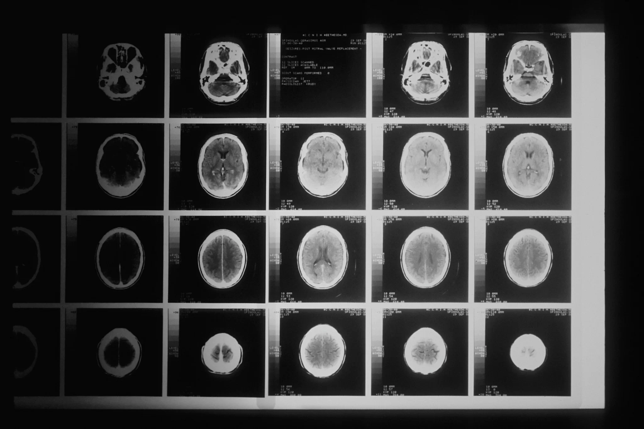 Una radiografia della testa presa da uno scanner tomografico assistito da computer. Questa tecnica è utile per la rivelazione del glioblastoma multiforme.