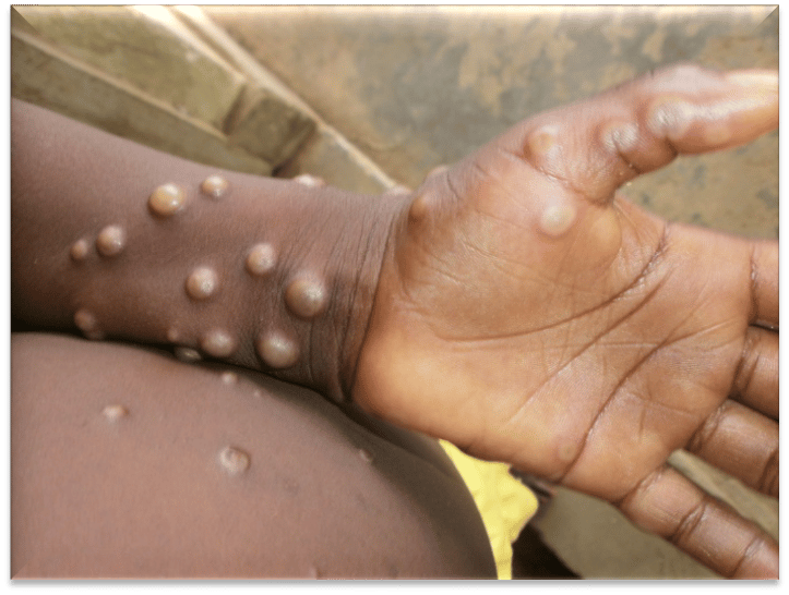 Credits: Nigeria Centre for Disease Control