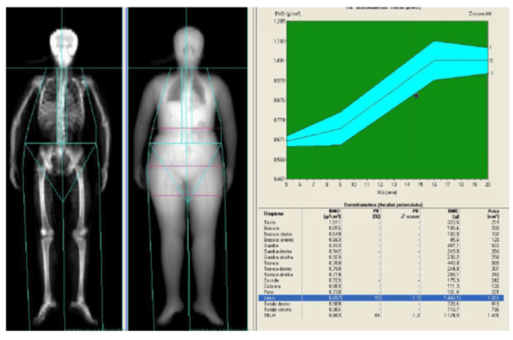 Dexa eseguita su un quindicenne con sindrome di Turner - Webinar: 'Osteoporosi. Malattia dell'età pediatrica che si manifesta in età geriatrica', 2020