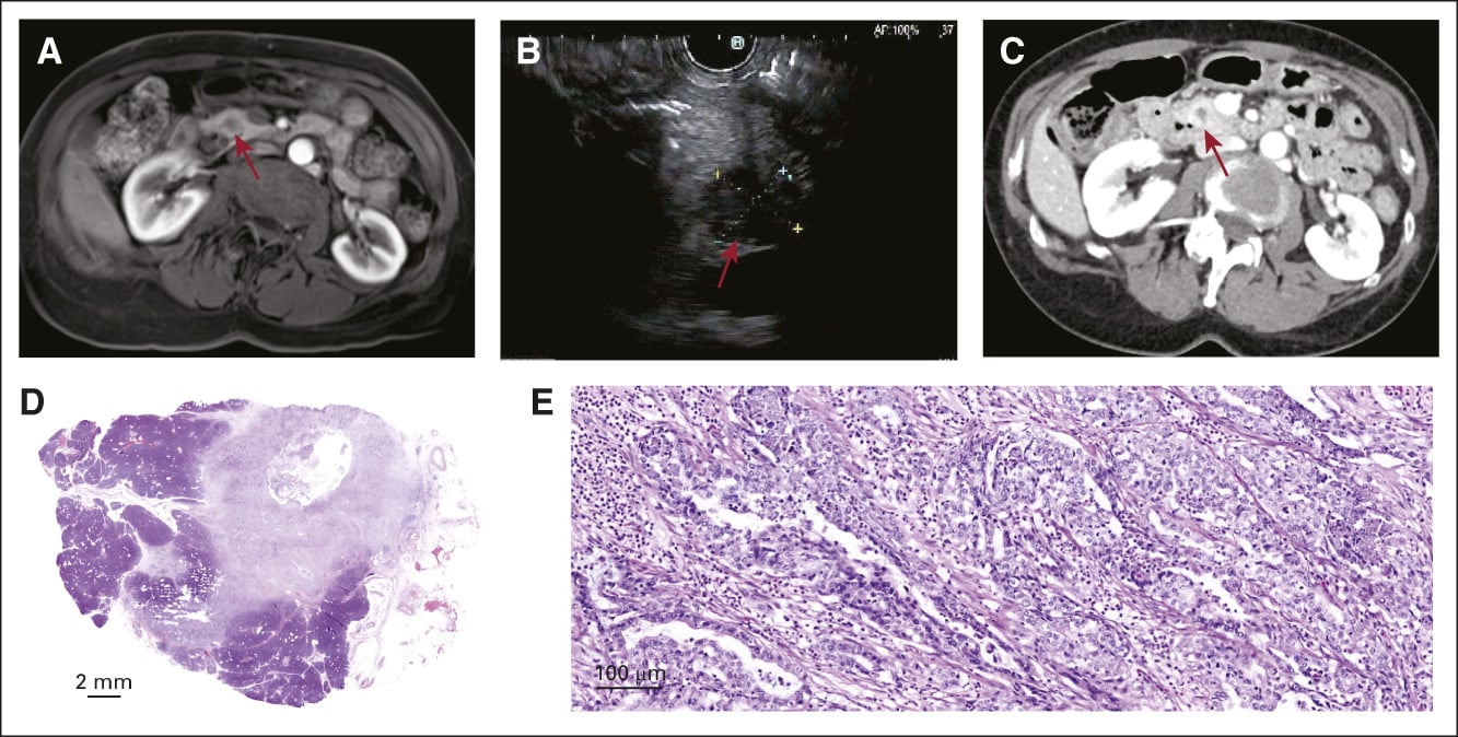 Esempio di carcinoma pancreatico stadio IA rilevato nello studio. (A) Risonanza magnetica di controllo che mostra una nuova lesione ipomigliorante di 1 cm nella testa del pancreas (freccia che punta alla massa). (B) Ultrasuoni endoscopici di conferma che 