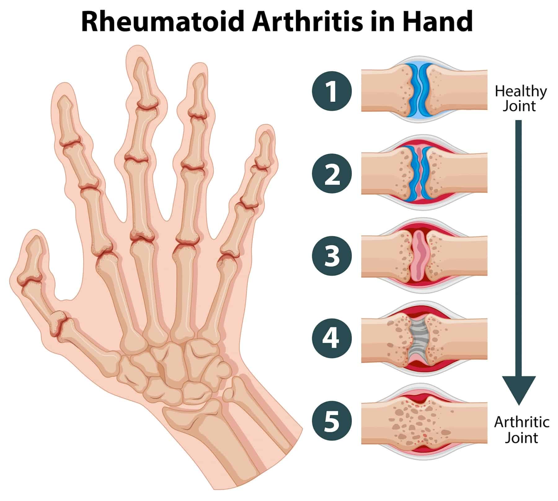 Evoluzione dell'artrite reumatoide sulla mano.
