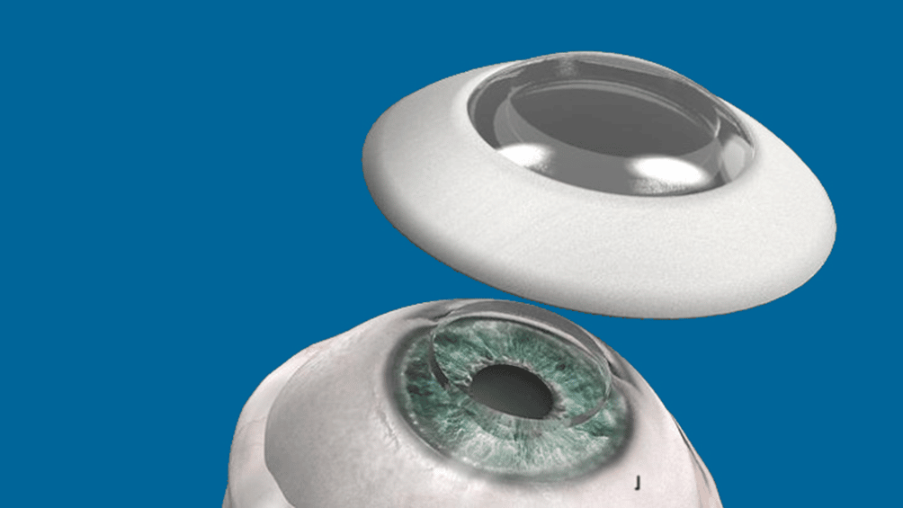 La cornea artificiale come una lente posta sopra l'occhio