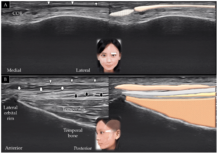 Scansione longitudinale del sopracciglio (A) e scansione longitudinale del muscolo orbitale (B) - 'Ultrasound Imaging of the Facial Muscles and Relevance with Botulinum Toxin Injections: A Pictorial Essay and Narrative Review'