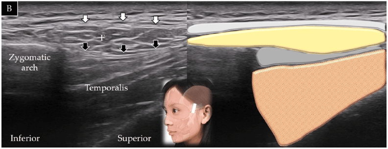 Scansione ecografica longitudinale (A) e sagittale (B) del muscolo temporale - 'Ultrasound Imaging of the Facial Muscles and Relevance with Botulinum Toxin Injections: A Pictorial Essay and Narrative Review'