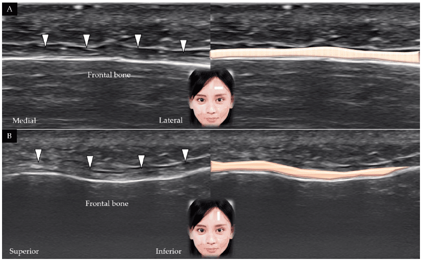 Scansione ecografica longitudinale (A) e sagittale (B) del muscolo frontale - 'Ultrasound Imaging of the Facial Muscles and Relevance with Botulinum Toxin Injections: A Pictorial Essay and Narrative Review'