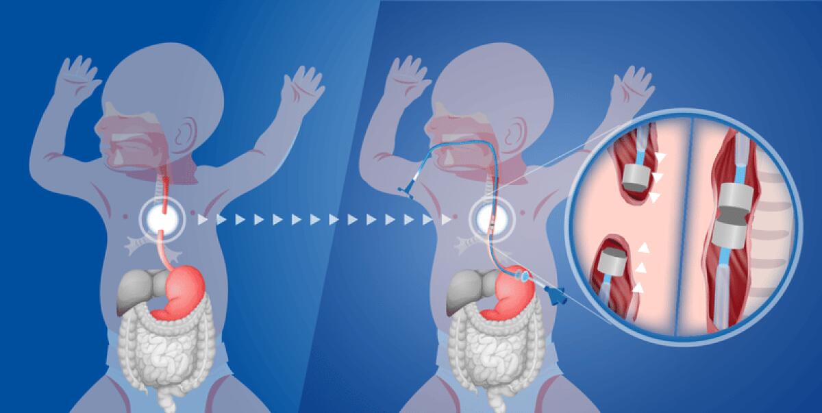 È possibile riparare l’esofago di un neonato tramite dei magneti? - 
