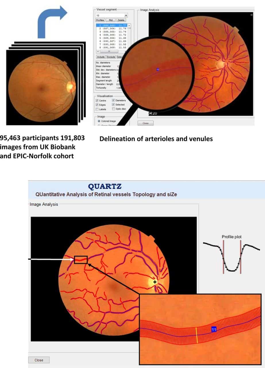 Nell'immagine si può vedere un elaborazione dell'immagine retinica completamente automatizzata dell'albero vascolare utilizzando il software QUARTZ abilitato per l'intelligenza artificiale - Credits: British Journal of Ophthalmology
