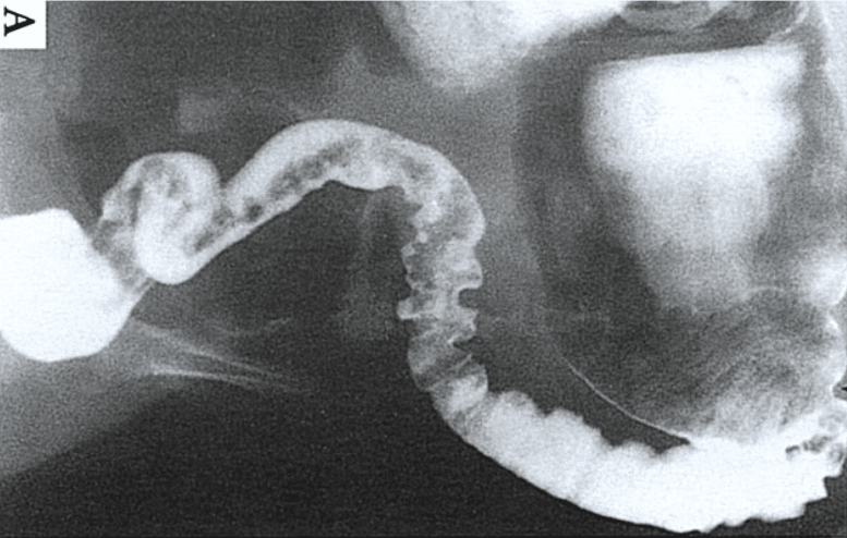 Malattia di Hirschsprung diagnosticata tramite la radiografia di un intestino sottoposto a clistere baritato. Credits: Gastroenterology and Hepatology: Colon, Rectum, and Anus. Edited by M Feldman (series editor) and CR Boland. Philadelphia, Current Medic