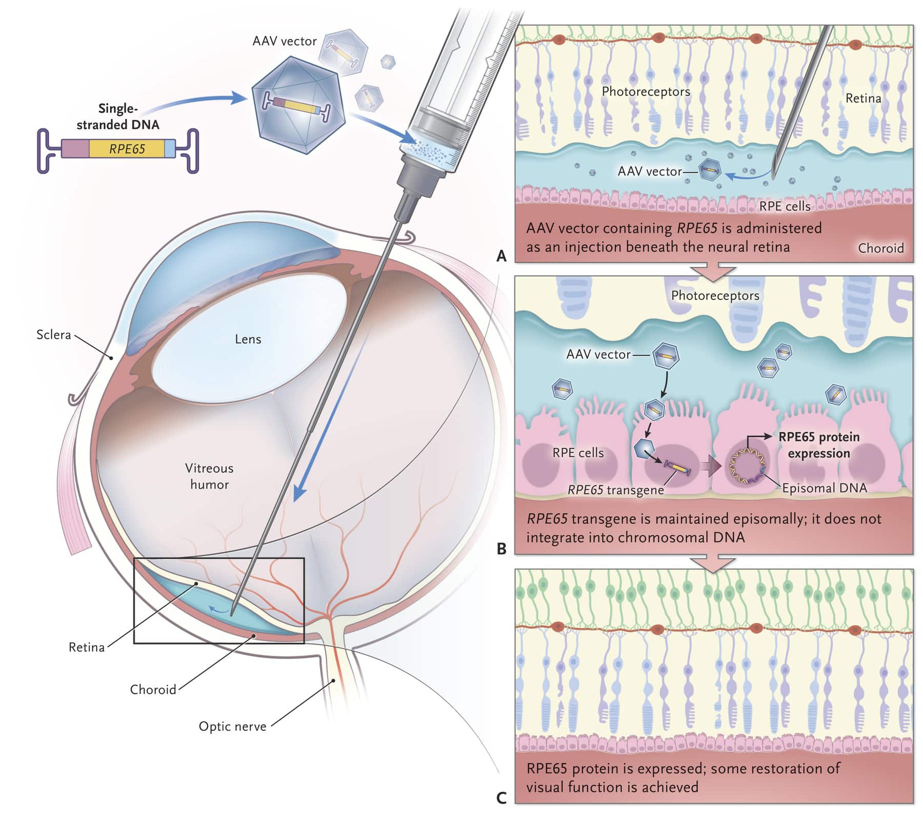 Approccio Terapeutico con Tecnologia Genica per la cura dei difetti del gene RPE65 con la terapia approvata dall’AIFA. Credits: Creative Diagnostics – High, KA.; Roncarolo, MG 2019.