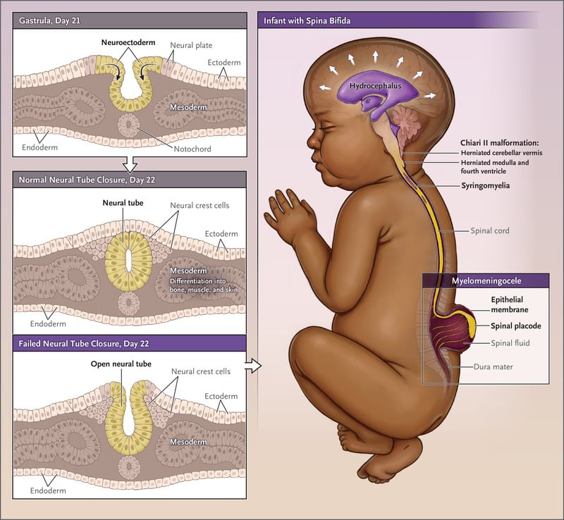 Spina bifida - Credits: The New England Journal of Medicine
