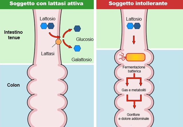 Processo di malassorbimento di lattosio a seguito di assenza di lattasi