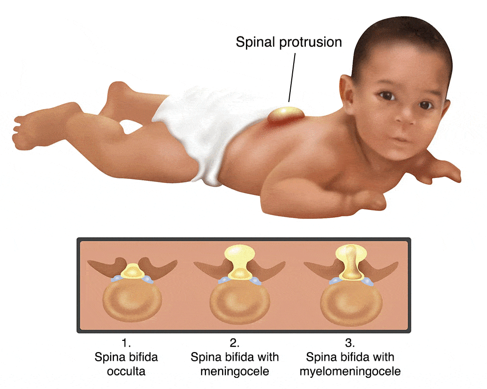 Tipologie di spina bifida schematizzate - Credits: Healthdirect Australia
