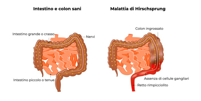 Confronto tra intestino sano ed intestino con malattia di Hirschsprung. Credits: TeachMe Pediatric Hirschsprung desease