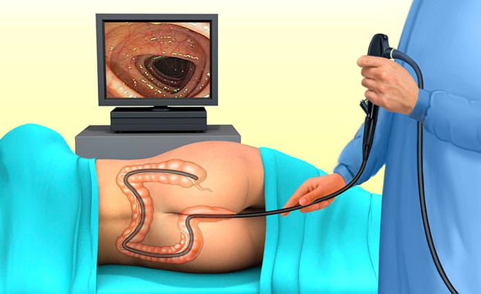 Posizionamento paziente durante colonscopia. Credits: colonproctologia.info