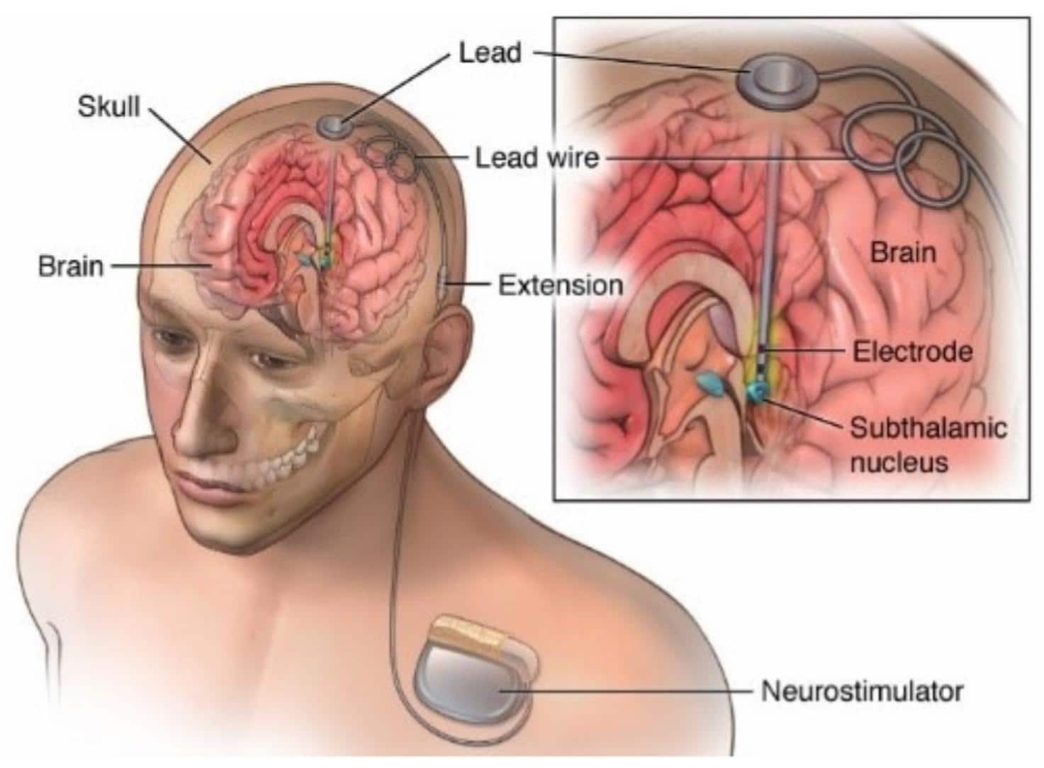 Concept of deep-brain stimulation (DBS). Credits: Nordi, T.M.; Gounella, R.H.; Luppe, M.; Junior, J.N.S.; Fonoff, E.T.; Colombari, E.; Romero, M.A.; Carmo, J.P.P.d. Low-Noise Amplifier for Deep-Brain Stimulation (DBS). Electronics 2022