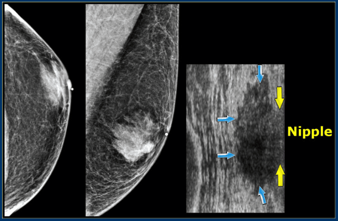 Immagine mammografica e immagine ecografica a confronto per individuare un pattern ghiandolare in un paziente con ginecomastia. Credits: Radiology Assistant