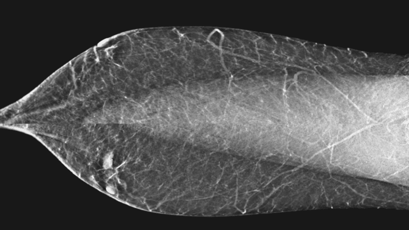 Mammografia di un tumore al seno maschile. credits: Radiological features of male breast disease,our experience: pictorial essay, 2022
