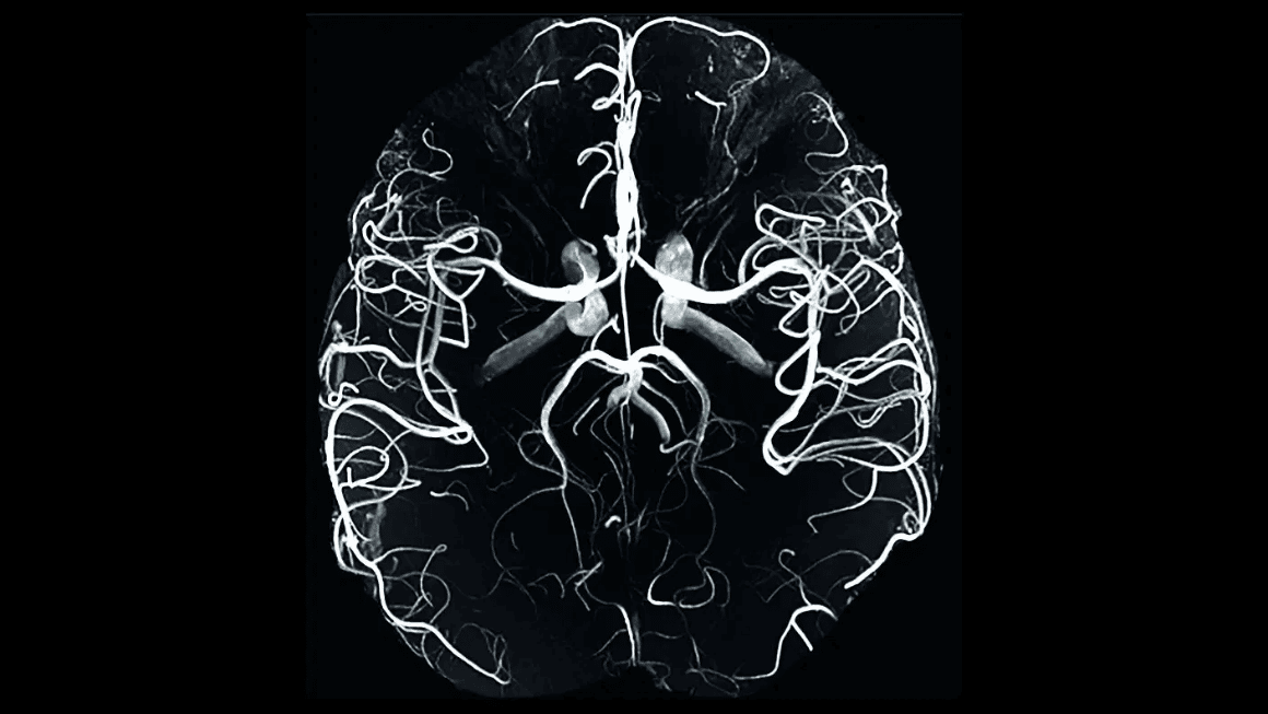 Un’immagine ottenuta utilizzando un macchinario di RMN a 7 Tesla: i dettagli dei vasi sanguigni, anche quelli più piccoli, sono visibili. Credits: Siemens Healthineers