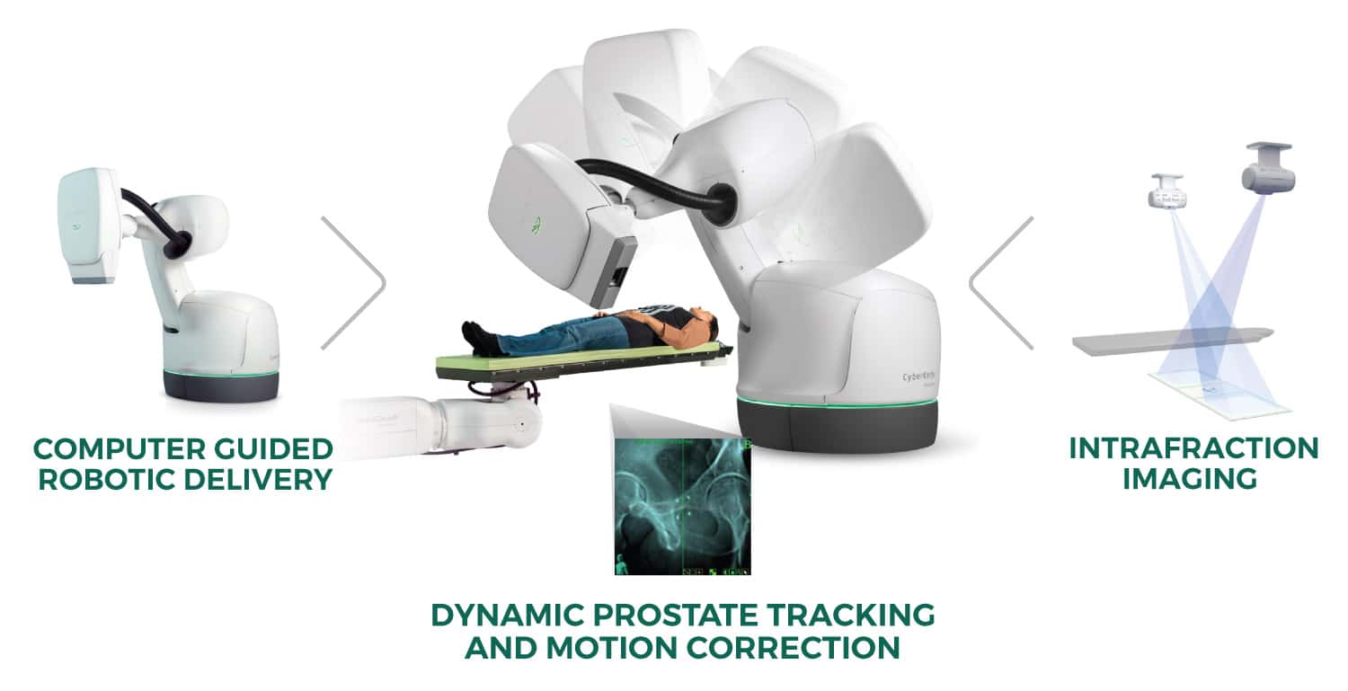 Funzionamento del sistema Cyberknife nel caso del trattamento di un tumore alla prostata - Credits: cyberknifeoc.com