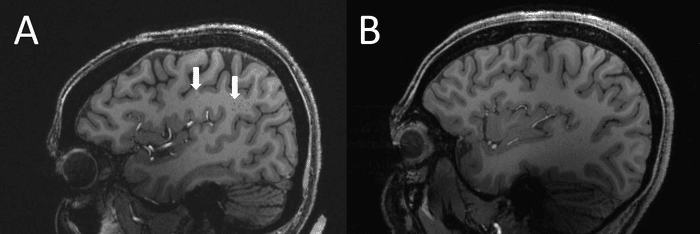(A) Spazi perivascolari con centrum semiovale ingrandito (frecce) su risonanza magnetica sagittale ponderata in T1 in un caso con emicrania cronica. (B) Controllo senza emicrania senza centrum semiovale ingrandito - Credits: RSNA e Wilson Xu