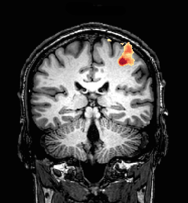 Esempio di immagine di fMRI cerebrale: l'area che risulta più attiva è indicata sull'immagine con delle macchioline rosse, arancio e gialle a seconda dell'intensità del segnale Credit: Socrates fMRI