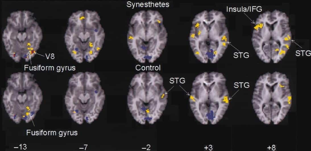 fMRI su soggetti sinesteti: l'esperienza di questi sembra essere più intensa rispetto a soggetti normali sottoposti allo stimolo sensoriale primario. Credits: Nature Neuroscience