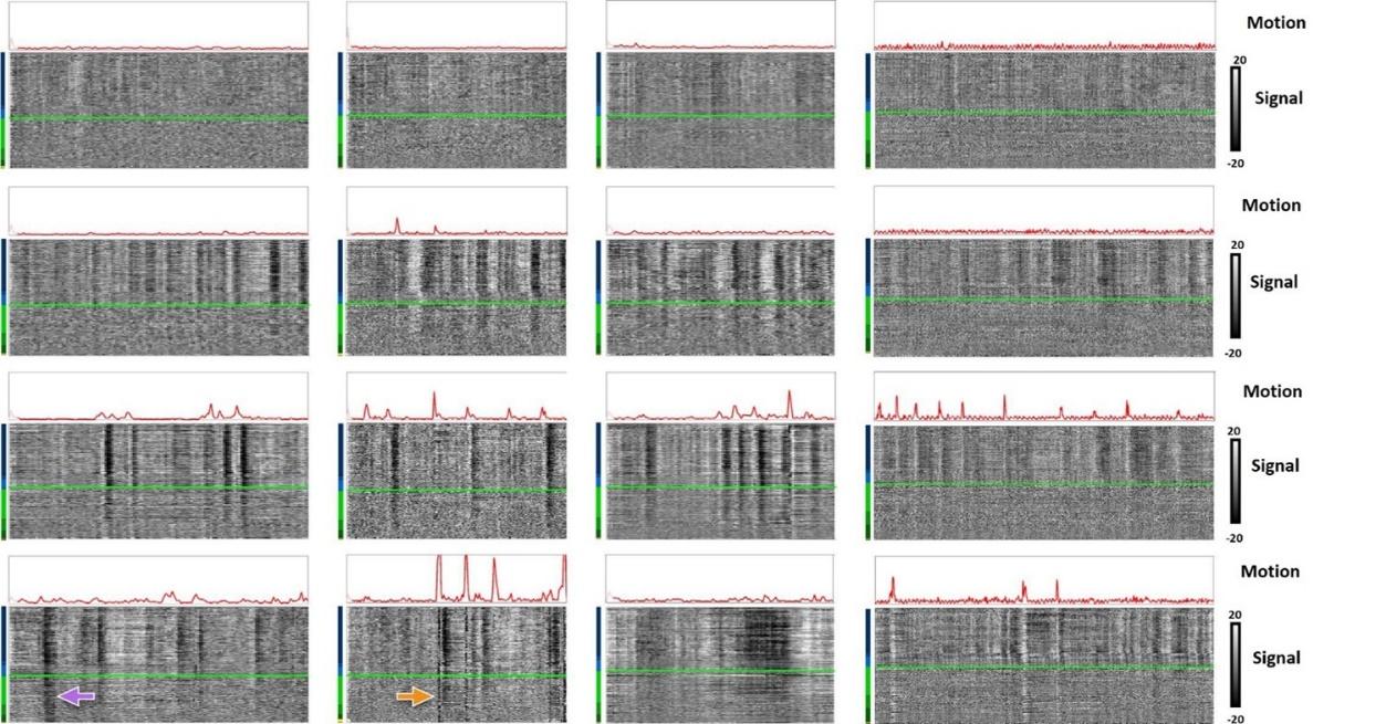 Le 4 tipologie di segnali whole-brain finora osservati: è interessante osservare in seconda riga come in alcuni soggetti questi possono variare anche in assenza di movimento del paziente (escludendo di fatto artefatti e rumore) Credits: NeuroImage
