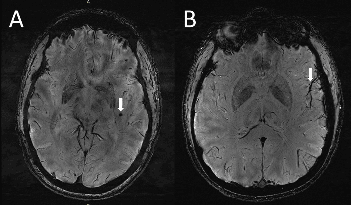 (A) Piccole aree emorragiche del parenchima cerebrale visualizzate come lesioni tonde e scure (freccia) sul lobo temporale sinistro in un caso di emicrania con aura. (B) Visibile asimmetria nell’aspetto dei vasi corticali e più prominente nel lato sinistr