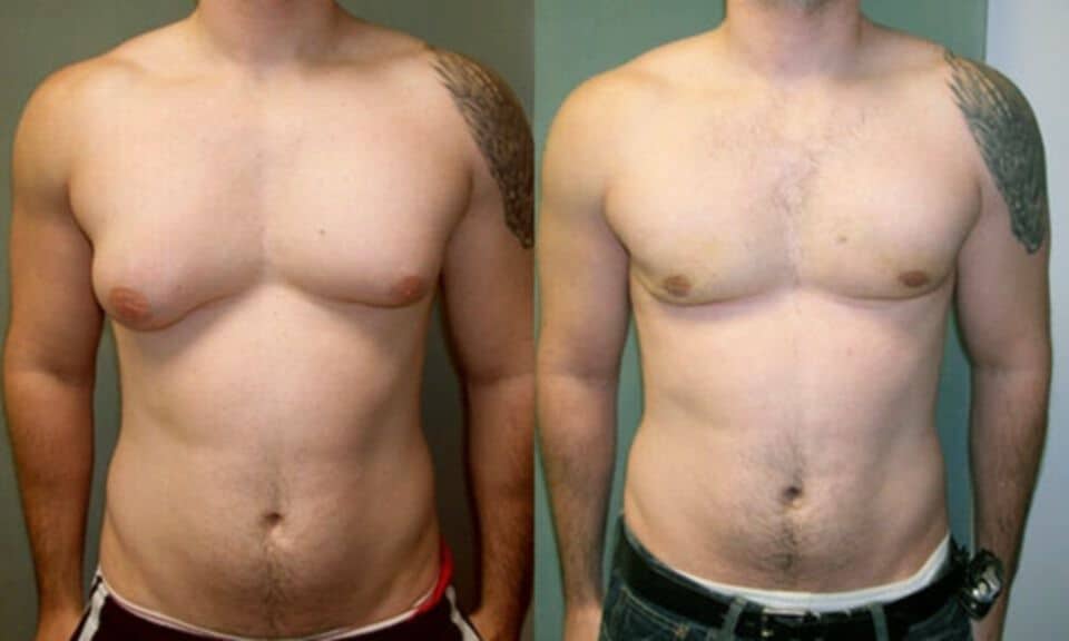 Esempio di un paziente con ginecomastia prima e dopo l'intervento chirurgico. Credits: Drug-induced gynecomastia: A systematic review and meta-analysis of randomized clinical trials, 2021