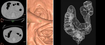 Ricostruzione 3D dell’intestino ottenuta da immagini TC. Credits: eosmed.it