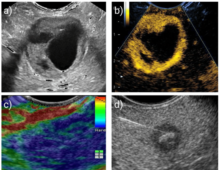 a) Ecografia endoscopica in B-mode; b) ecogradia endoscopica a contrasto; c) elastografia; d) ecografia con aspirazione con ago.  Credits: Healthcare in Europe