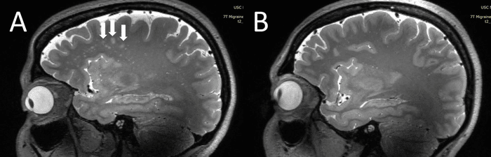 (A) Iperintensità della sostanza bianca profonda (frecce) su risonanza magnetica sagittale ponderata in T2 in paziente con emicrania in atto. (B) Controllo senza emicrania senza sostanza bianca profonda punteggiata - Credits: RSNA e Wilson Xu