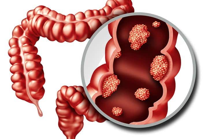 Diagnosi precoce del tumore al colon-retto attraverso colonscopia virtuale