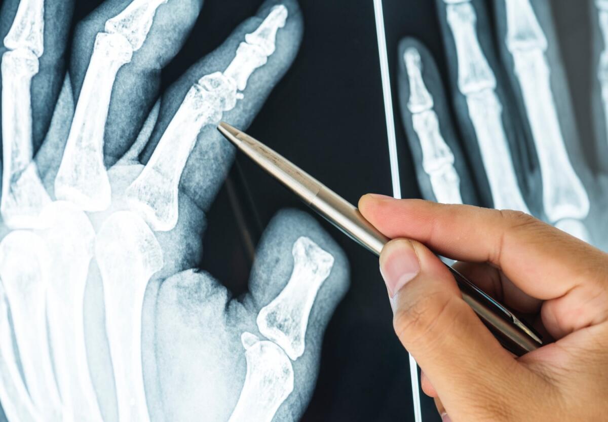 AI: FingerKIt articolazioni personalizzate per dita danneggiate - 